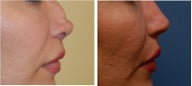 Non-Surgical Rhinoplasty