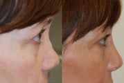 Non-Surgical Rhinoplasty with Silikon-1000. Profile refinement after previous rhinoplasty surgery.