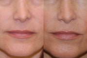 Non-Surgical Rhinoplasty with Silikon-1000. Nostril lowering after previous rhinoplasty surgery.
