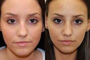 Non-Surgical Rhinoplasty with Silikon-1000. 3 treatments.