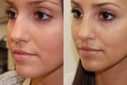 Non-Surgical Rhinoplasty and Lip Augmentation with Silikon-1000