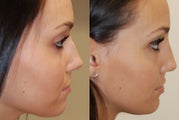 Non-Surgical Rhinoplasty with Silikon-1000. 3 treatments