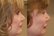 Non-Surgical Rhinoplasty with Silikon-1000. 2 treatments.