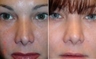 Non surgical nose job
