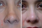 Non Surgical Rhinoplasty