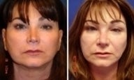 Non Surgical Rhinoplasty