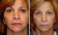 Non Surgical Rhinoplasty