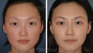 Blepharoplasty and Rhinoplasty