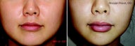 Lip Augmentation with Perlane