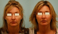 Injectable Fillers (Restylane/Perlane)