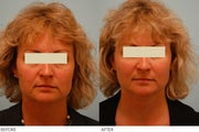 Injectable Fillers (Restylane/Perlane)