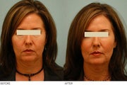 Injectable Fillers (Restylane/Perlane)