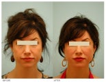 Injectable Fillers (Restylane/Perlane)