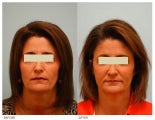 Injectable Fillers (Restylane/Perlane)
