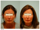 Injectable Fillers (Restylane/Perlane)