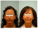 Injectable Fillers (Restylane/Perlane)