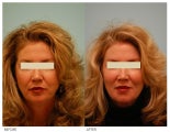 Injectable Fillers (Restylane/Perlane)
