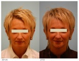 Injectable Fillers (Restylane/Perlane)