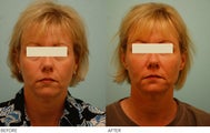 Injectable Fillers (Restylane/Perlane)