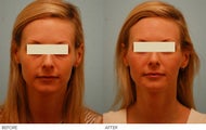 Injectable Fillers (Restylane/Perlane)