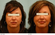 Injectable Fillers (Restylane/Perlane)