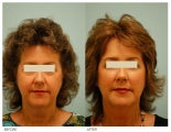Injectable Fillers (Restylane/Perlane)