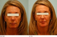 Injectable Fillers (Restylane/Perlane)