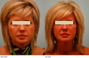 Injectable Fillers (Restylane/Perlane)