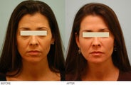 Injectable Fillers (Restylane/Perlane)