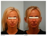 Injectable Fillers (Restylane/Perlane)