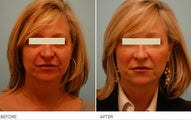 Injectable Fillers (Restylane/Perlane)
