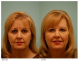 Botox, Fillers