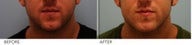 Male Lower Face Enhancement