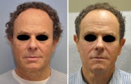 Facial Rejuvenation with Filler