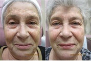 Photofacial IPL
