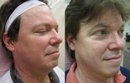 Intense pulsed light (IPL) photofacial for severe sun damage