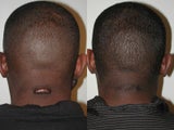 Keloid Excision