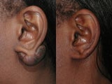 Keloid Excision