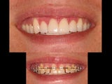 Whitening and porcelain veneers