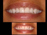 Porcelain veneers to close gaps