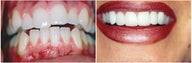 Veneers