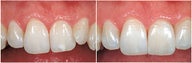 Empress Veneers