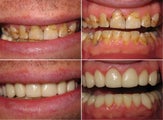 Empress Veneers