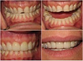 Veneers