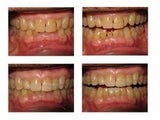 Three Veneers Placed