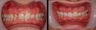 veneers