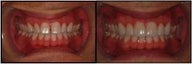 Porcelain Veneers