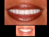 Porcelain veneers