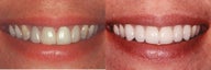 Porcelain Veneers