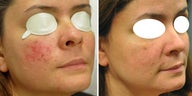 Pulsed Dye Laser for Blood Vessels